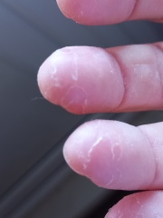 Peeling skin on fingertips - any ideas? Definitely NOT because I don't moisturise ;-)