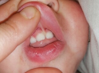 1 year old chipped tooth - worried!!