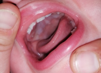 1 year old chipped tooth - worried!!