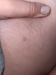 Red patch on upper thigh??