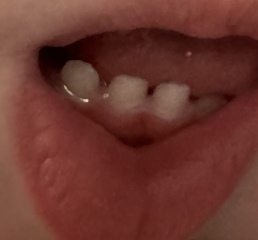 14 months teeth