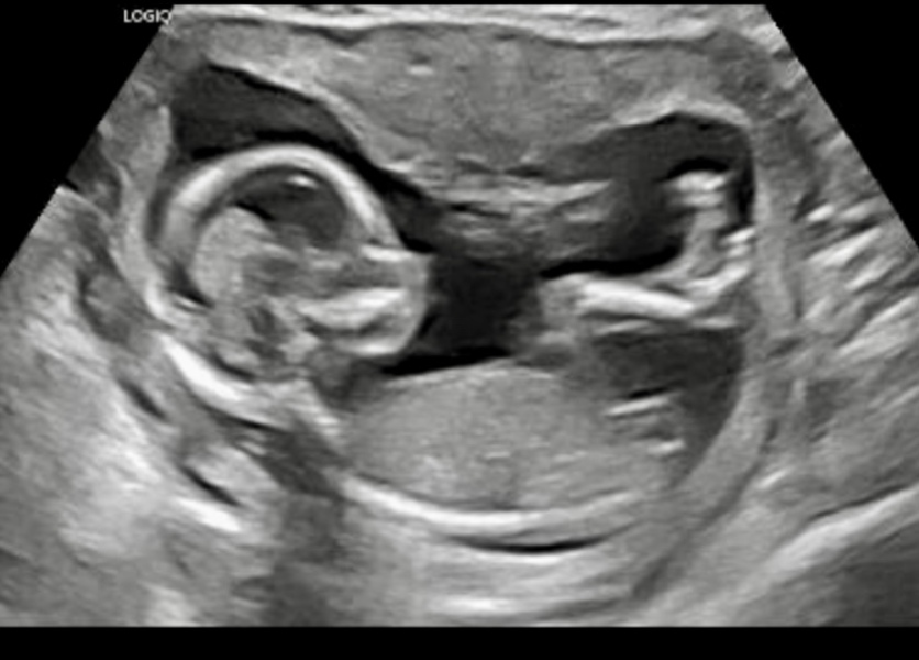 BFP after IVF - the journey continues (part 2)