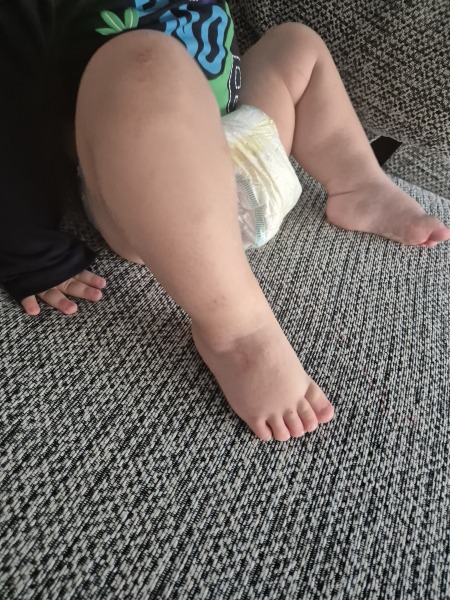 Drought secret cream on eczema!