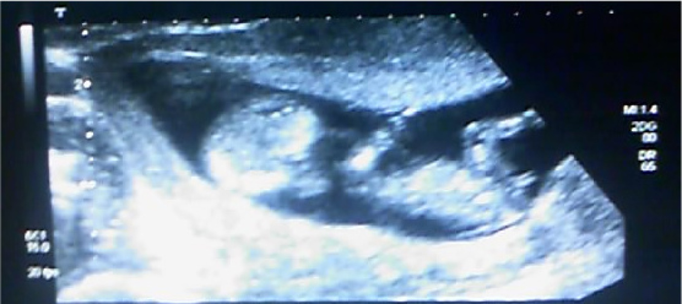 Nub theory errors?