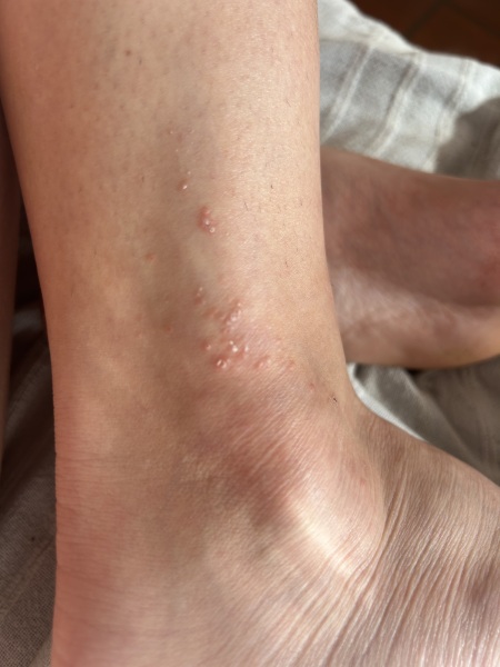 What are these spots on my ankles (photo)