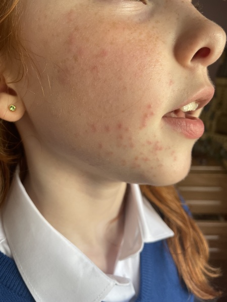 11 year old DD sudden rash on face