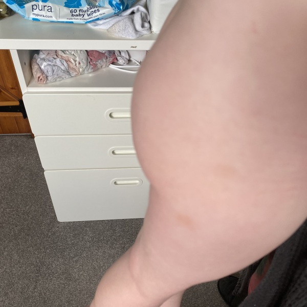 Am I right to be worried about these bruises?
