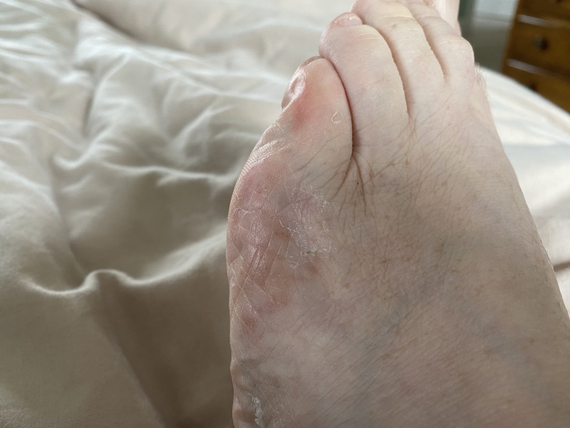Hand infected (Warning, gross photos)