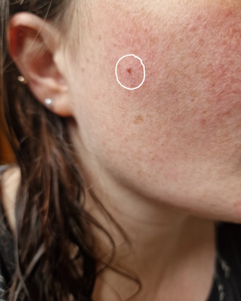 To get this tiny mole on face looked at?