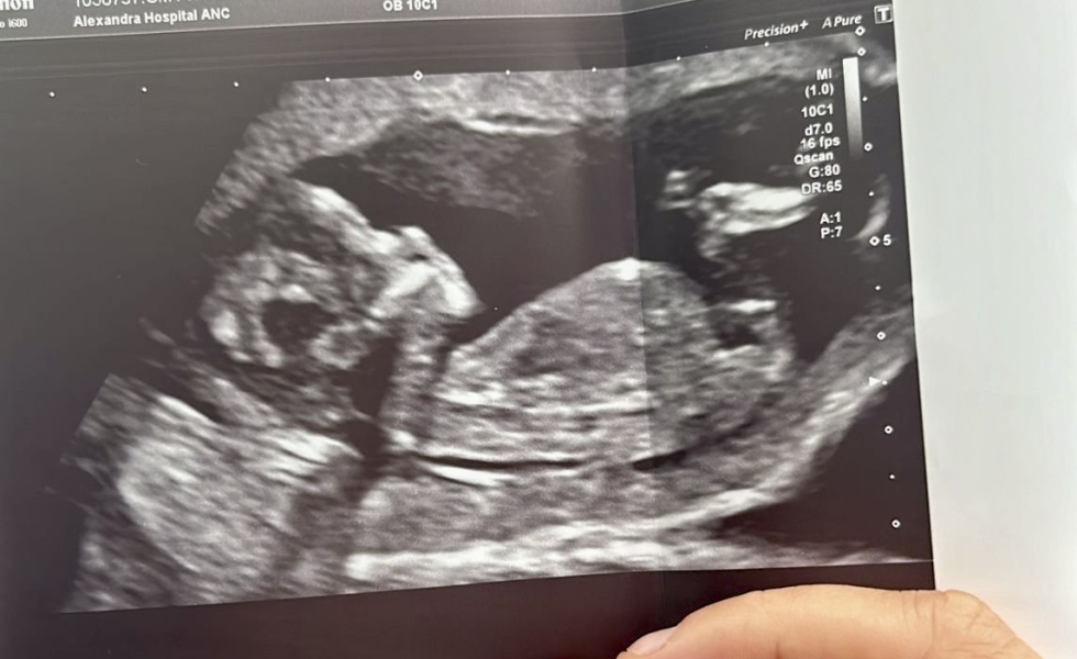 Boy 🩵 or Girl 🩷? Add your 12 week scans and guesses!