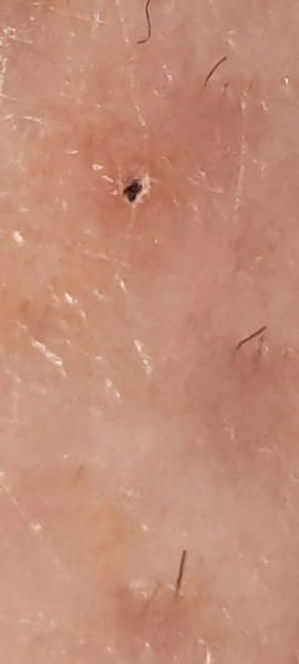 Tick bite, please calm me -photos.