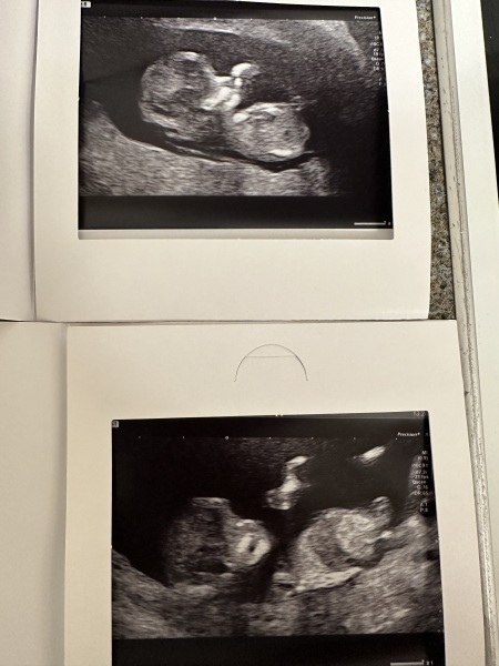 Nub theory at 12+2. Girl or boy??