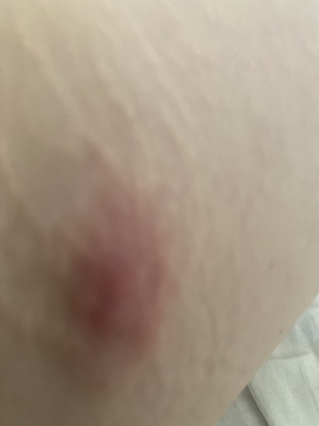 What is this on my hip?