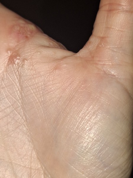 Hand infected (Warning, gross photos)