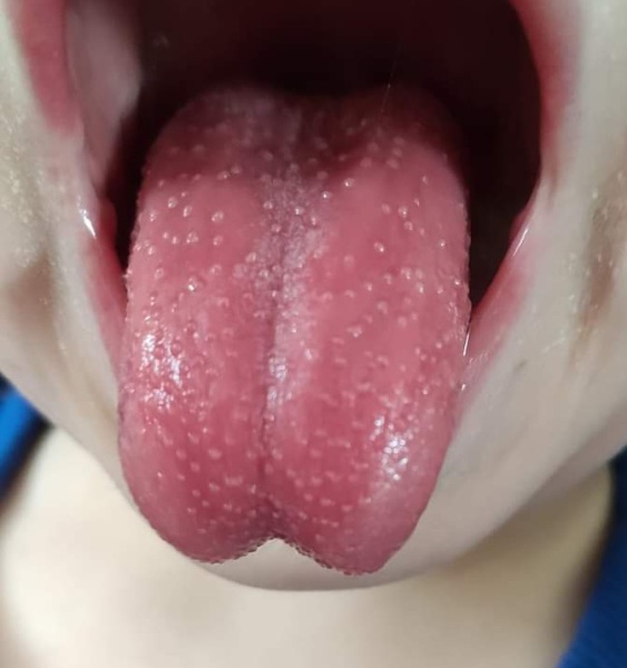 Could this be strawberry tongue from scarlet fever?