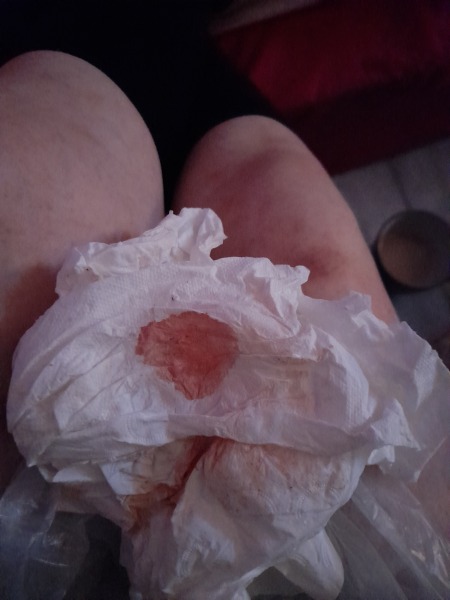 Is this implantation bleeding