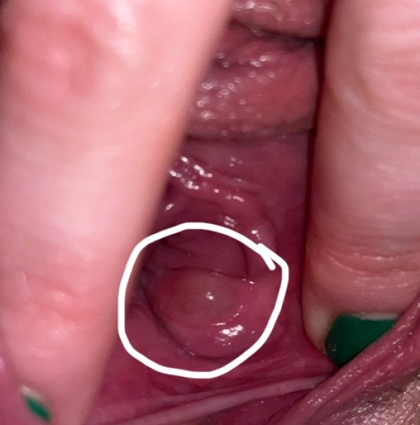 Bartholins cyst or something else? HELPPP
