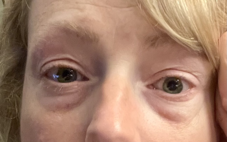 Please fix my eyebags