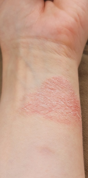Warning image included. What is this on my skin?
