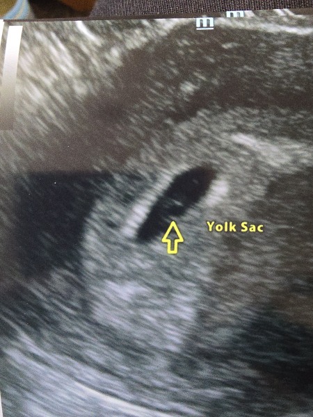 No fetal pole at 6 weeks - any stories?