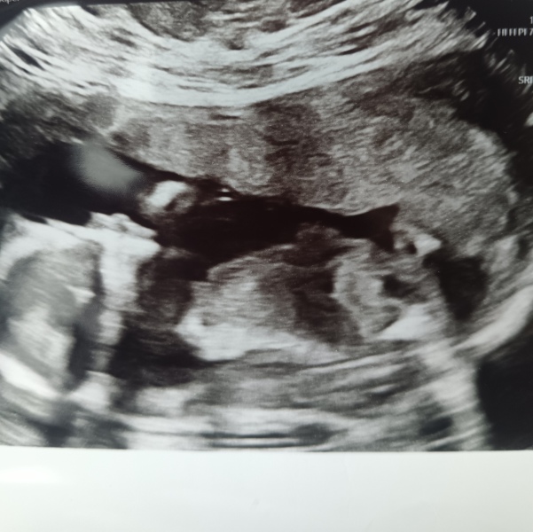 Ultrasound 16+5