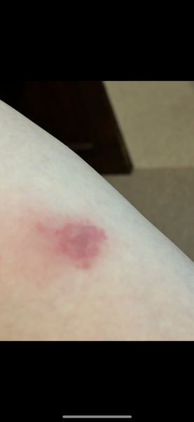 Infected bite?