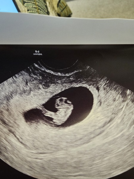 Strange hole in baby's head