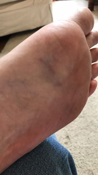 What is this bump on my foot?