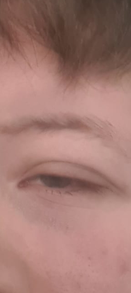 PTOSIS