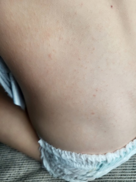 Fever and Rash (pictures!)