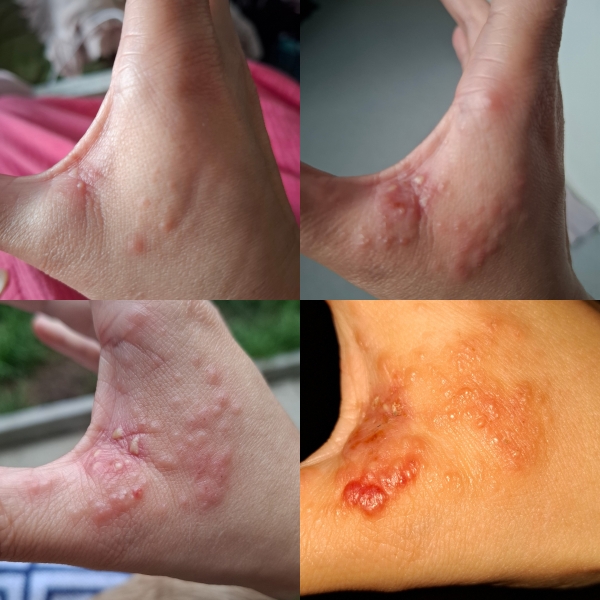 Hand infected (Warning, gross photos)
