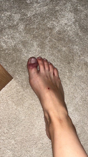 To be concerned about my toe