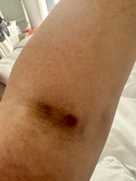 Hideous bruise from blood test