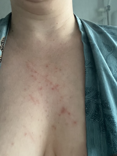 What’s this rash?