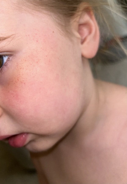 Rash on daughters cheeks