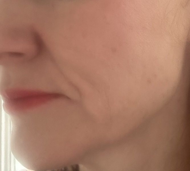 Not a suitable candidate for Botox?!