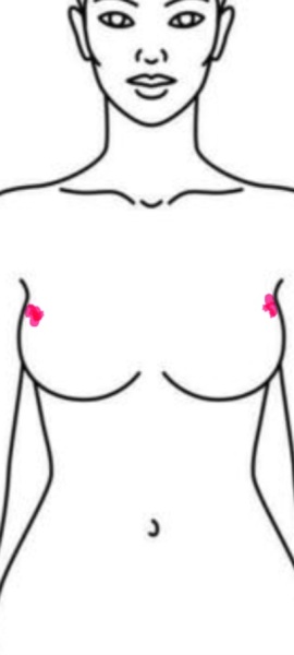 Breast lumps