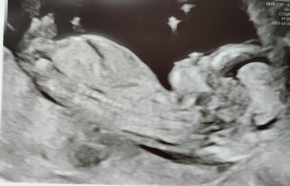 Nub theory - boy or girl?
