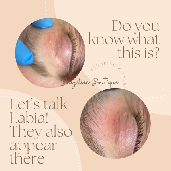 Small white spot on labia