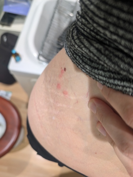 Bites! Help please