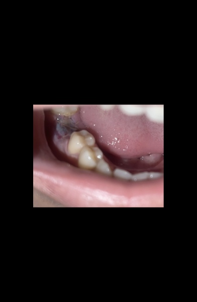 Tooth Extraction Healing