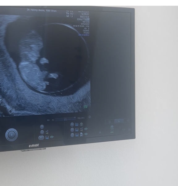 Nub theory - boy or girl?
