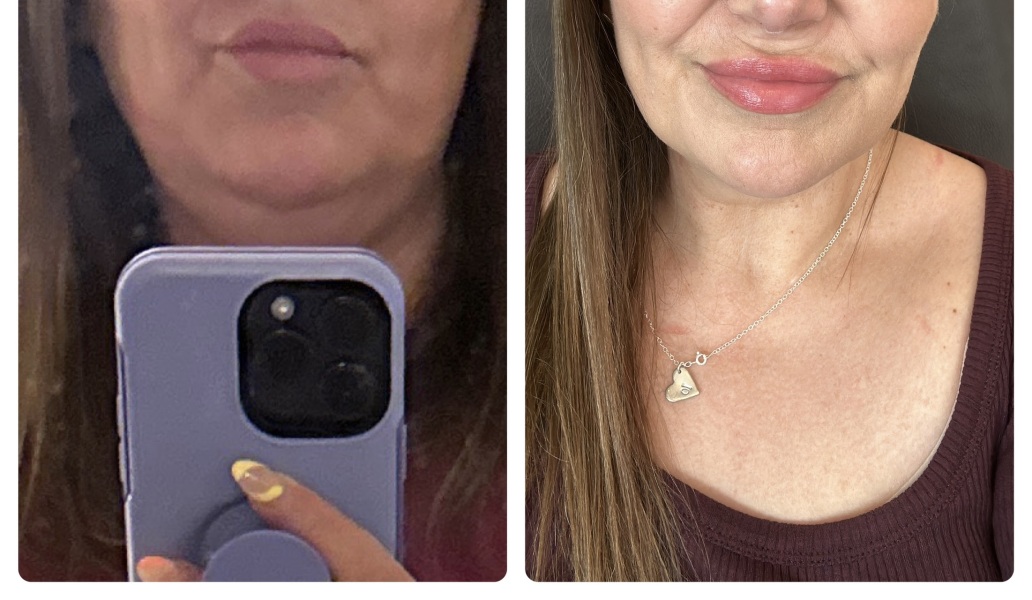 From triple chin to single chin - little progress pic