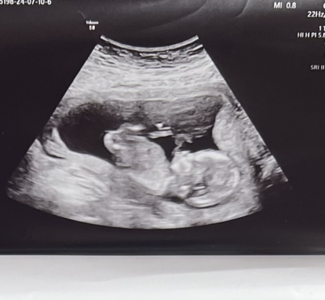 14 week scan