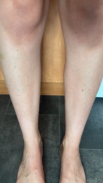 Blood clot in calf?