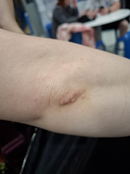 Hand infected (Warning, gross photos)