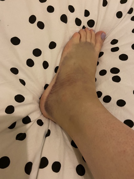 Sprained ankle still swollen after 10 days