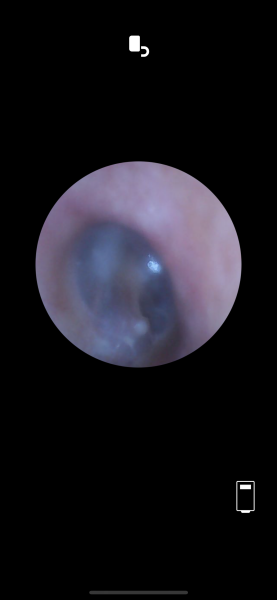 Any Drs or ear specialists on? Pic of eardrum