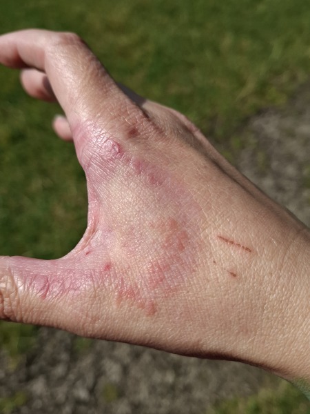 Hand infected (Warning, gross photos)