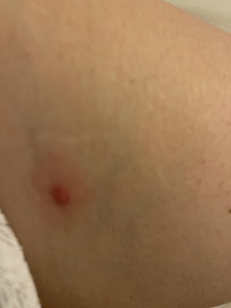 Lots of big red spots on shoulders and back